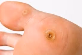 Two small verrucas (plantar warts) on the sole of the foot